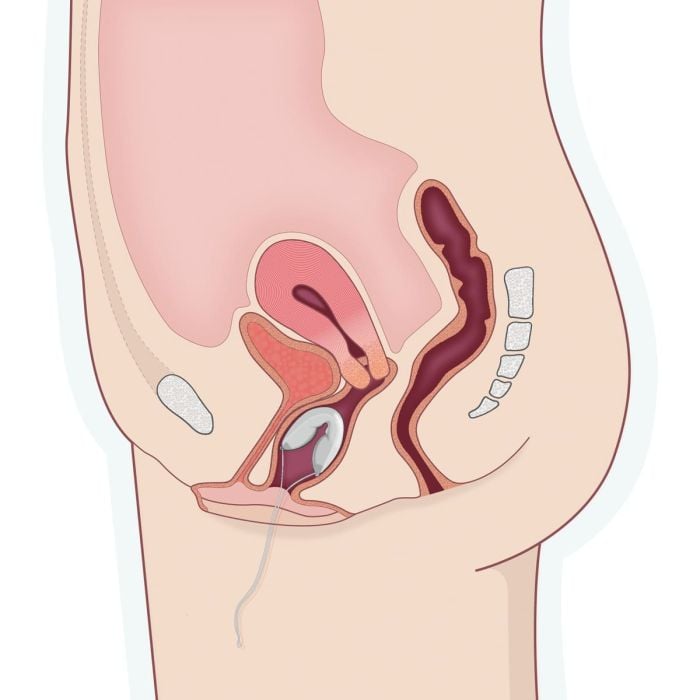 Contrelle Activgard Sizing Kit